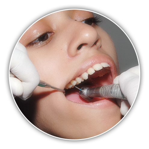 Treatment of Decay at Stoma Advanced Dental Care