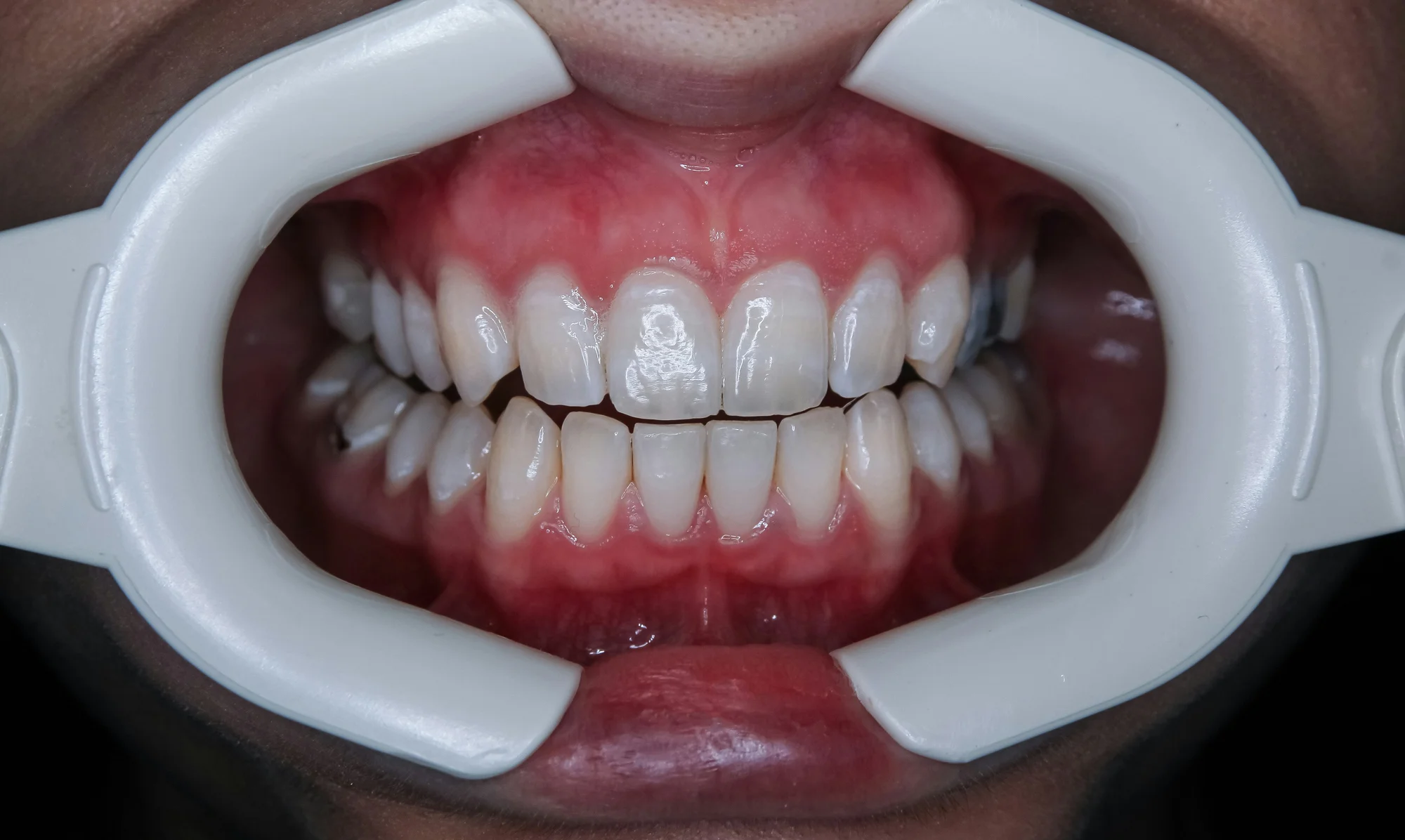 What is Full Mouth Rehabilitation?