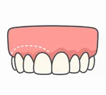 Types of Cosmetic Gum Procedures