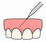 Types of Cosmetic Gum Procedures