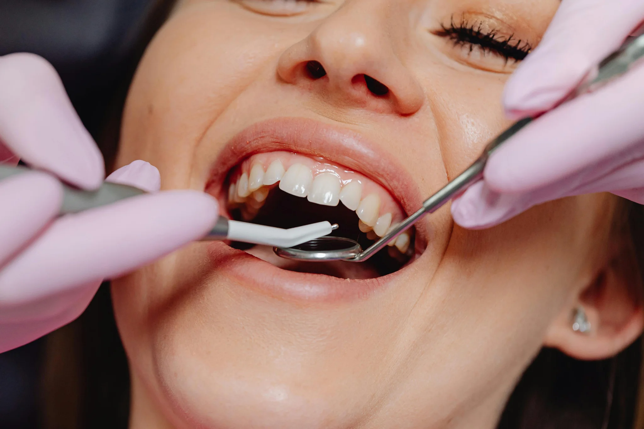 Cosmetic Gum Procedures