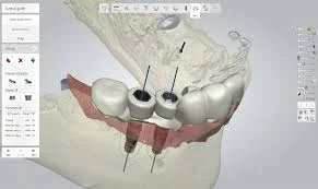 Guided Implant Technique
