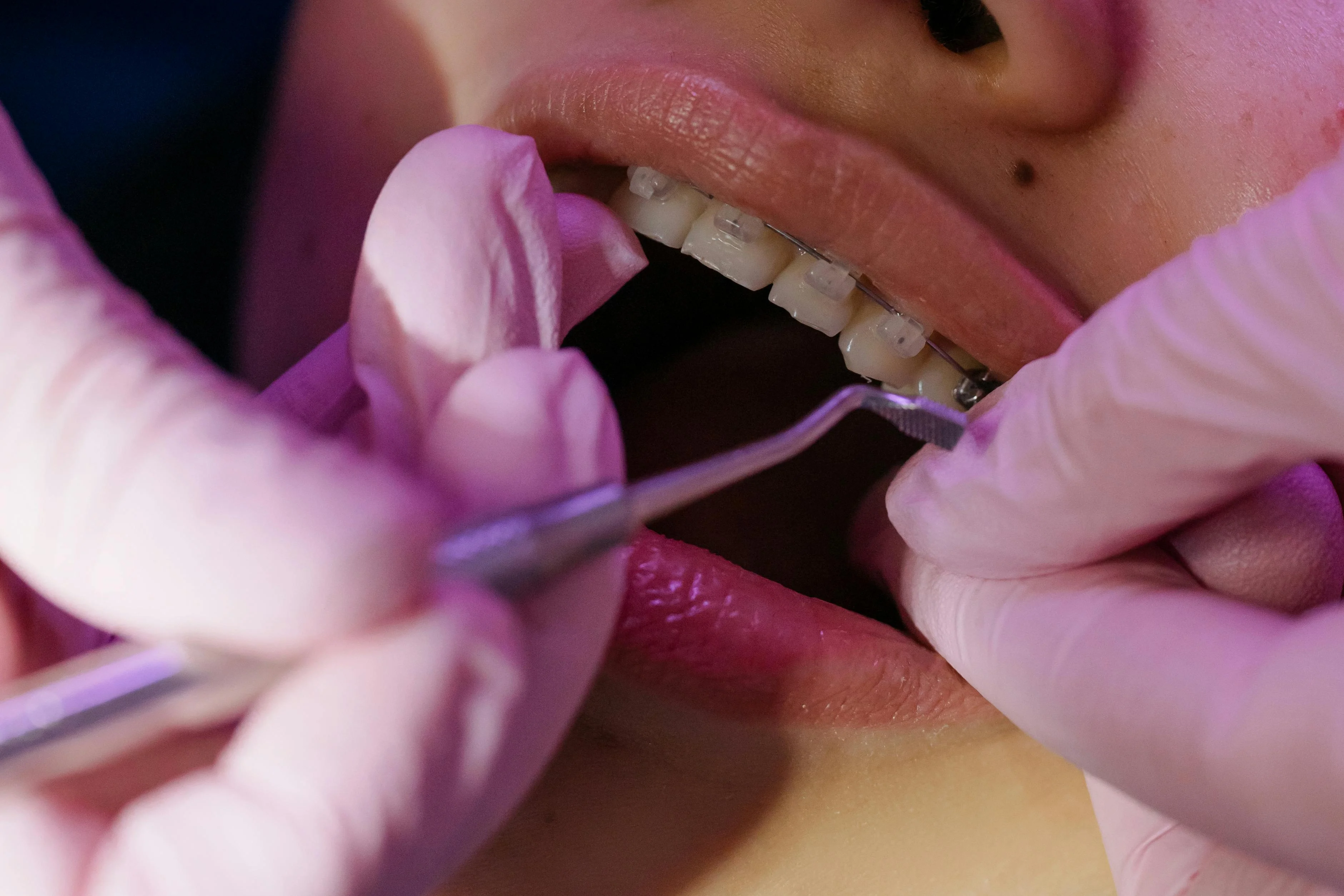 Benefits of Orthodontic Treatment