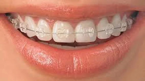 Types of Orthodontic Treatment