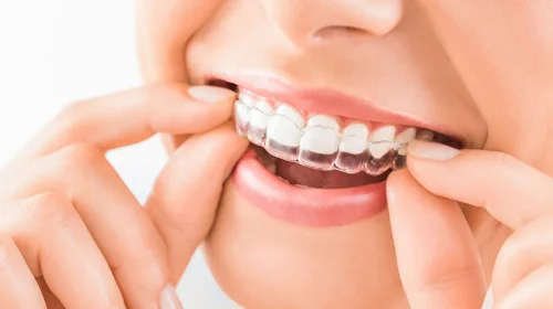Types of Orthodontic Treatment