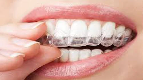 Clear Aligners
