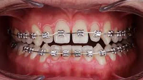 Types of Orthodontic Treatment