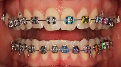 Metal Braces