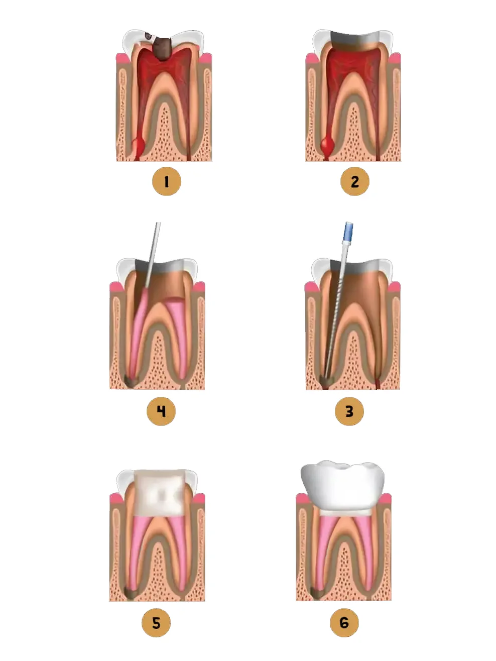 Root Canal RCT