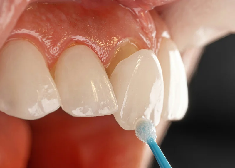 What Are Dental Veneers