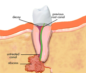 Root Canal