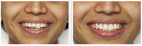 Smile Designing