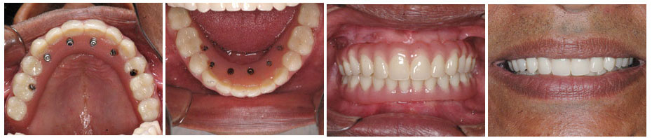 Graftless(Zygoma) Dental Implants