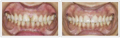 Smile Designing