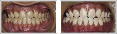 Smile Designing